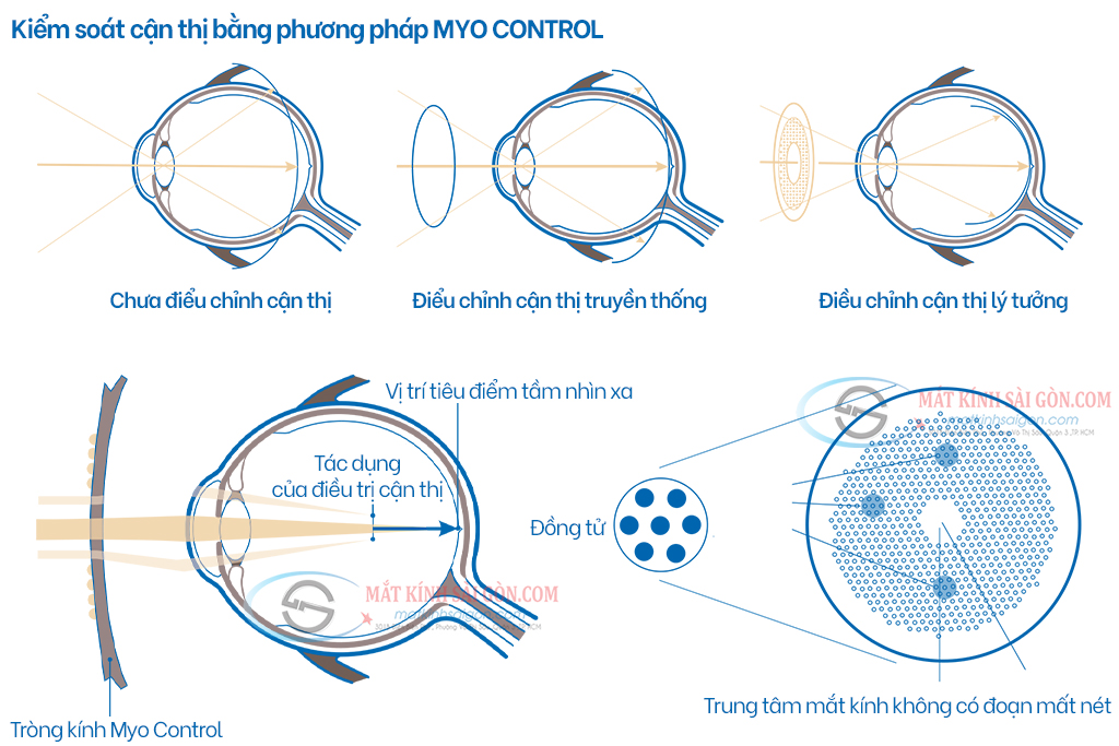 TRÒNG KÍNH 1.56 LEVALENS MYO CONTROL - Hover